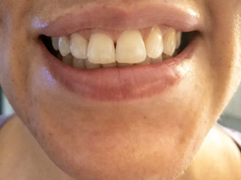 front view of my teeth before using the Smile Brilliant teeth whitening kit