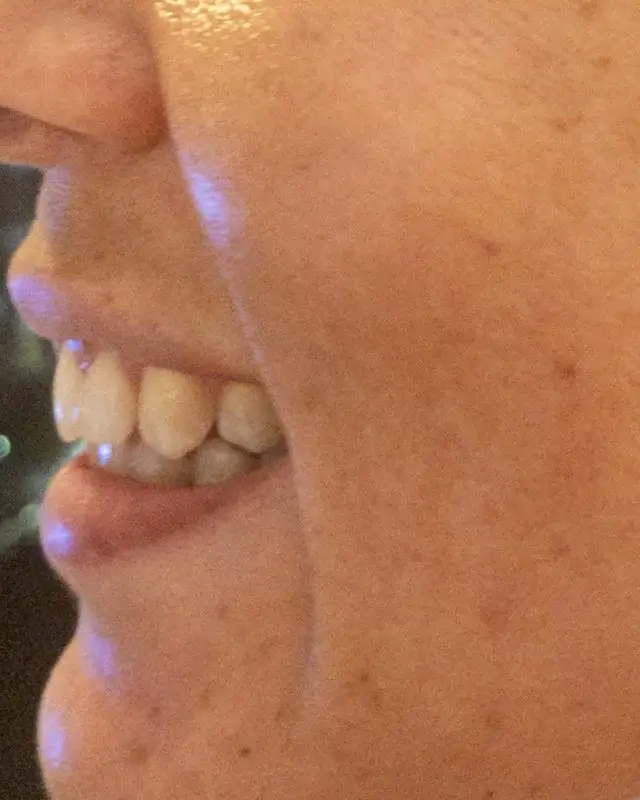 side view of my teeth before using the smile brilliant teeth whitening kit