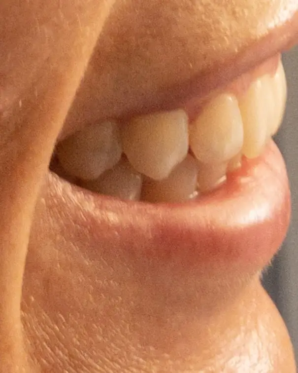 my teeth before using the Smile Brilliant teeth whitening kit