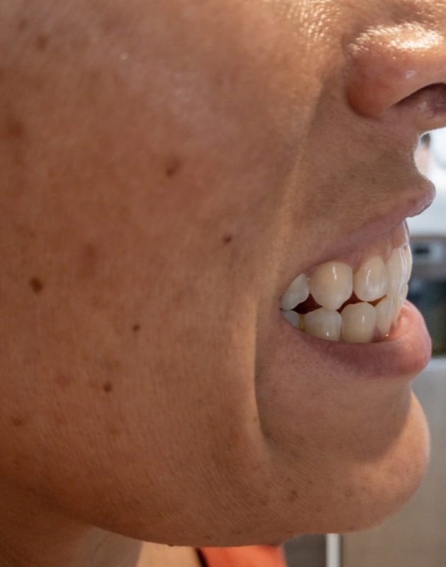 side view of my teeth after using the smile brilliant teeth whitening kit